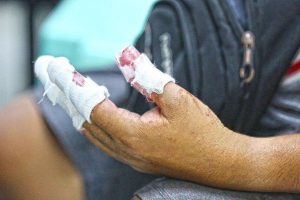 Fireworks-related injuries in Cordillera climb to 10